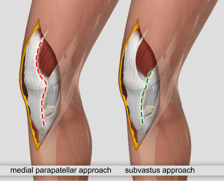 subvastus approach versuse traditional to total knee replacement