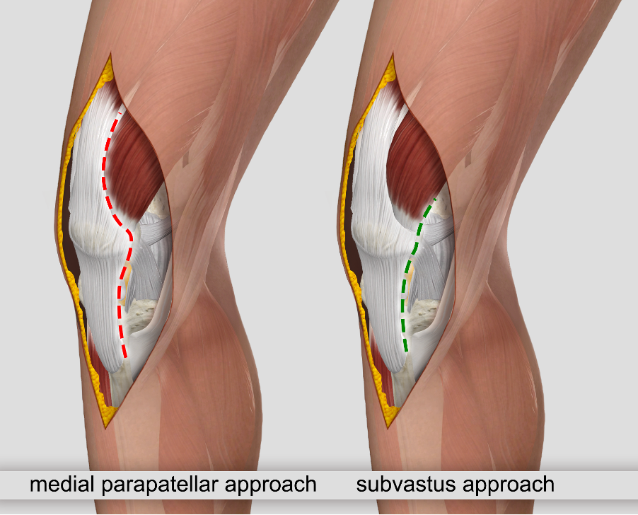 subvastus approach versuse traditional to total knee replacement